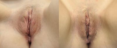 Labiaplasty Before & After Gallery - Patient 11681833 - Image 1