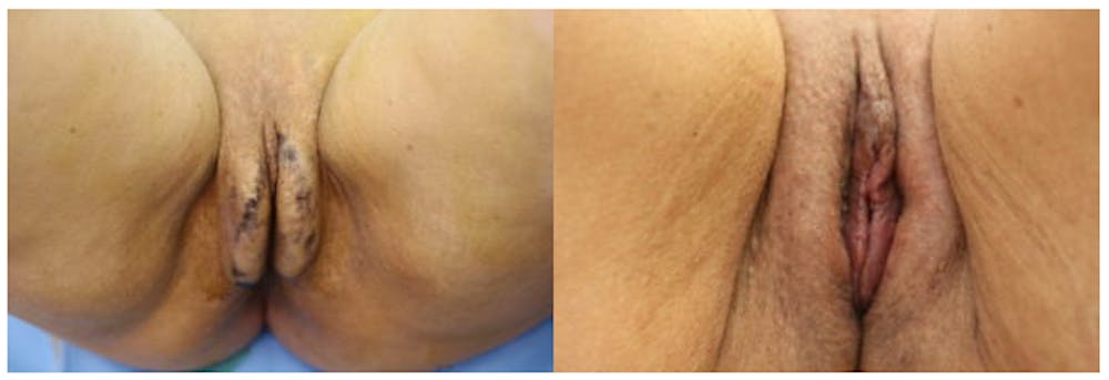 Labiaplasty Before & After Gallery - Patient 11681834 - Image 1