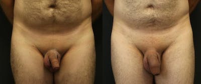 Non-Surgical Phalloplasty Before & After Gallery - Patient 11681849 - Image 1