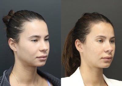 Aesthetic Facial Balancing Before & After Gallery - Patient 11682055 - Image 1