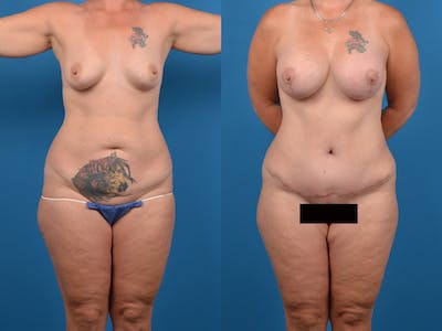 Abdominoplasty Before & After Gallery - Patient 14242432 - Image 1