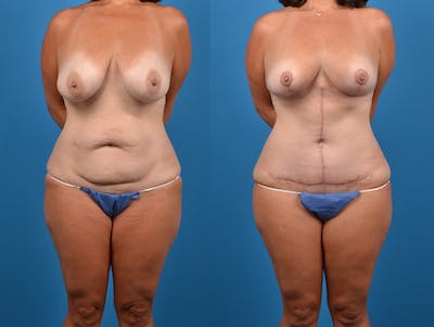 Abdominoplasty Before & After Gallery - Patient 14242433 - Image 1
