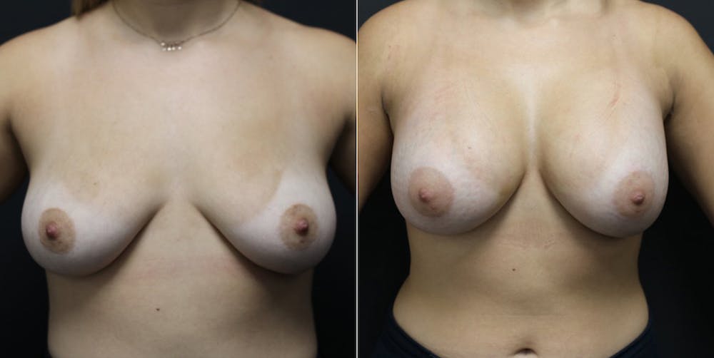 Breast Augmentation Before & After Gallery - Patient 14242461 - Image 1