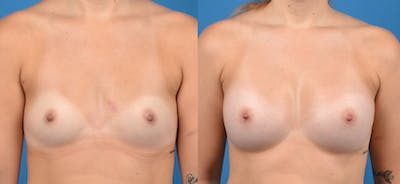 Breast Augmentation Before & After Gallery - Patient 14242463 - Image 1