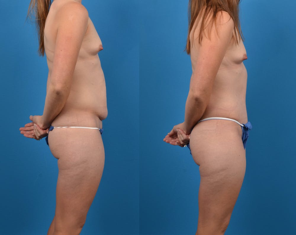 Abdominoplasty Before & After Gallery - Patient 14282482 - Image 2