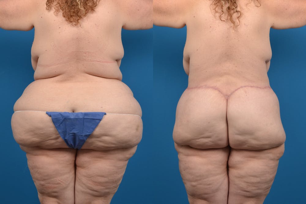 Post-Bariatric Surgery Before & After Gallery - Patient 14779239 - Image 3