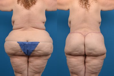 Liposuction Before & After Gallery - Patient 14391444 - Image 1