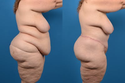 Post-Bariatric Surgery Before & After Gallery - Patient 14779239 - Image 1