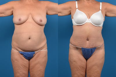 Abdominoplasty Before & After Gallery - Patient 14282492 - Image 1
