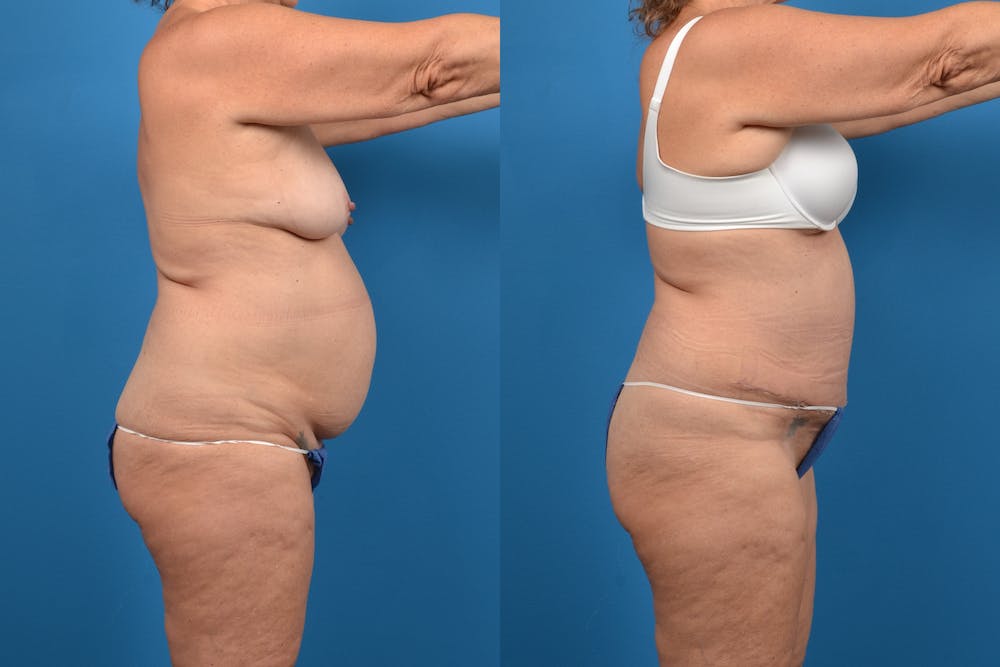 Abdominoplasty Before & After Gallery - Patient 14282492 - Image 3