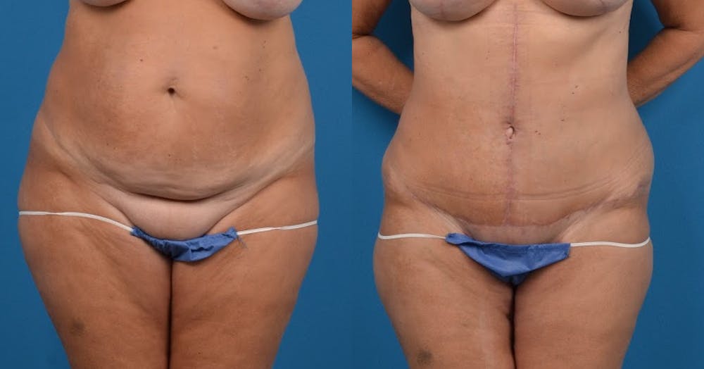 Abdominoplasty Before & After Gallery - Patient 14282518 - Image 1