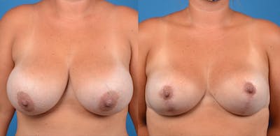 Breast Lift Before & After Gallery - Patient 14242475 - Image 1