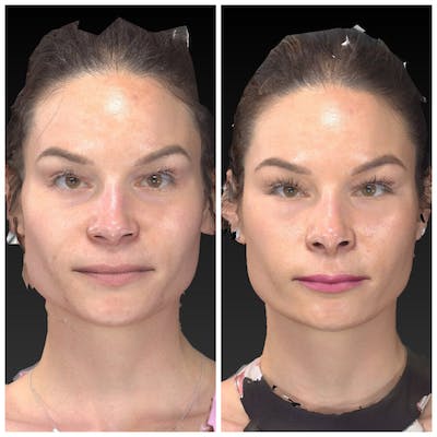 Aesthetic Facial Balancing Before & After Gallery - Patient 14282628 - Image 1