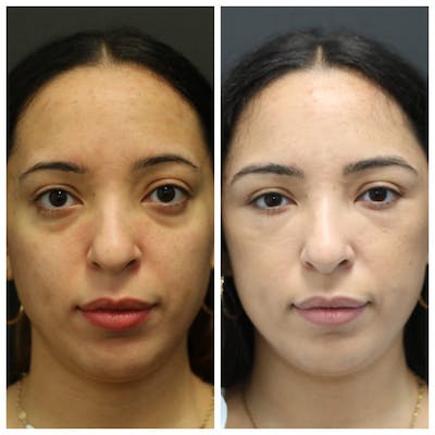 Aesthetic Facial Balancing Before & After Gallery - Patient 14282629 - Image 1