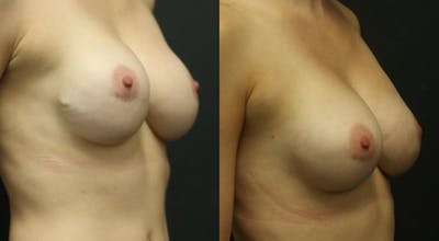 Breast Revision Before & After Gallery - Patient 11681813 - Image 1