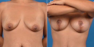 Breast Lift Before & After Gallery - Patient 11681987 - Image 1