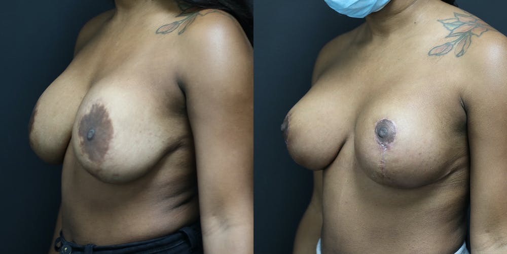 Breast Lift Before & After Gallery - Patient 14779143 - Image 2