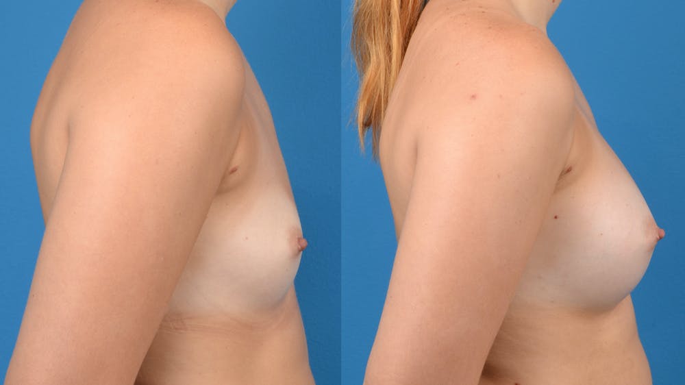 Breast Augmentation Before & After Gallery - Patient 14242463 - Image 5