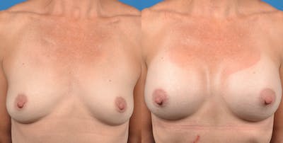 Breast Augmentation Before & After Gallery - Patient 14778322 - Image 1