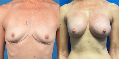 Breast Lift Before & After Gallery - Patient 14778675 - Image 1
