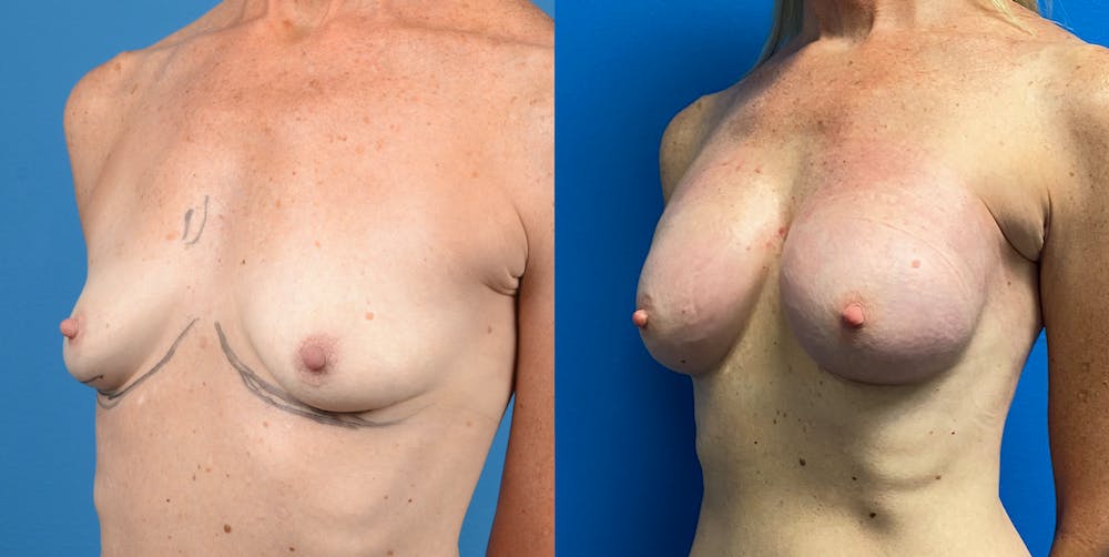 Breast Lift Before & After Gallery - Patient 14778675 - Image 3