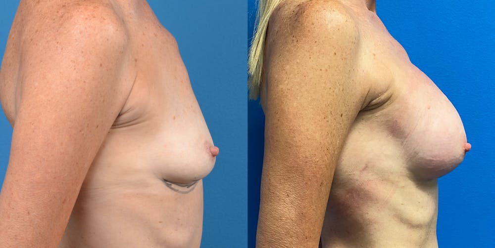 Breast Lift Before & After Gallery - Patient 14778675 - Image 5