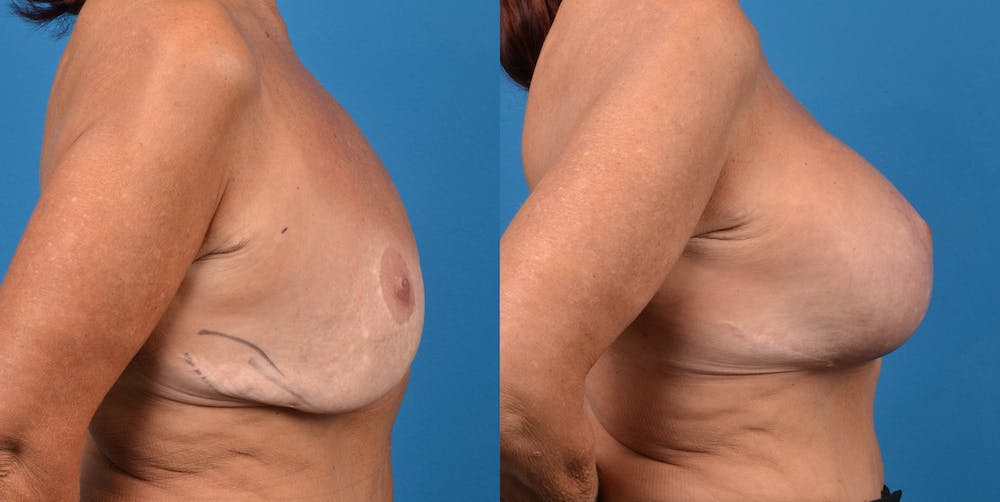 Breast Revision Before & After Gallery - Patient 14778924 - Image 5