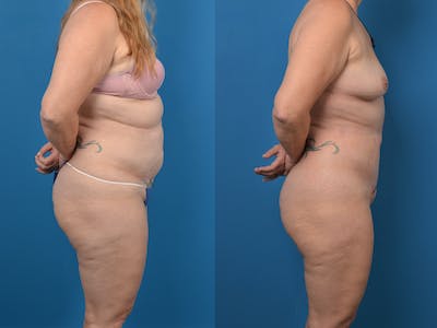 Abdominoplasty Before & After Gallery - Patient 14779077 - Image 1