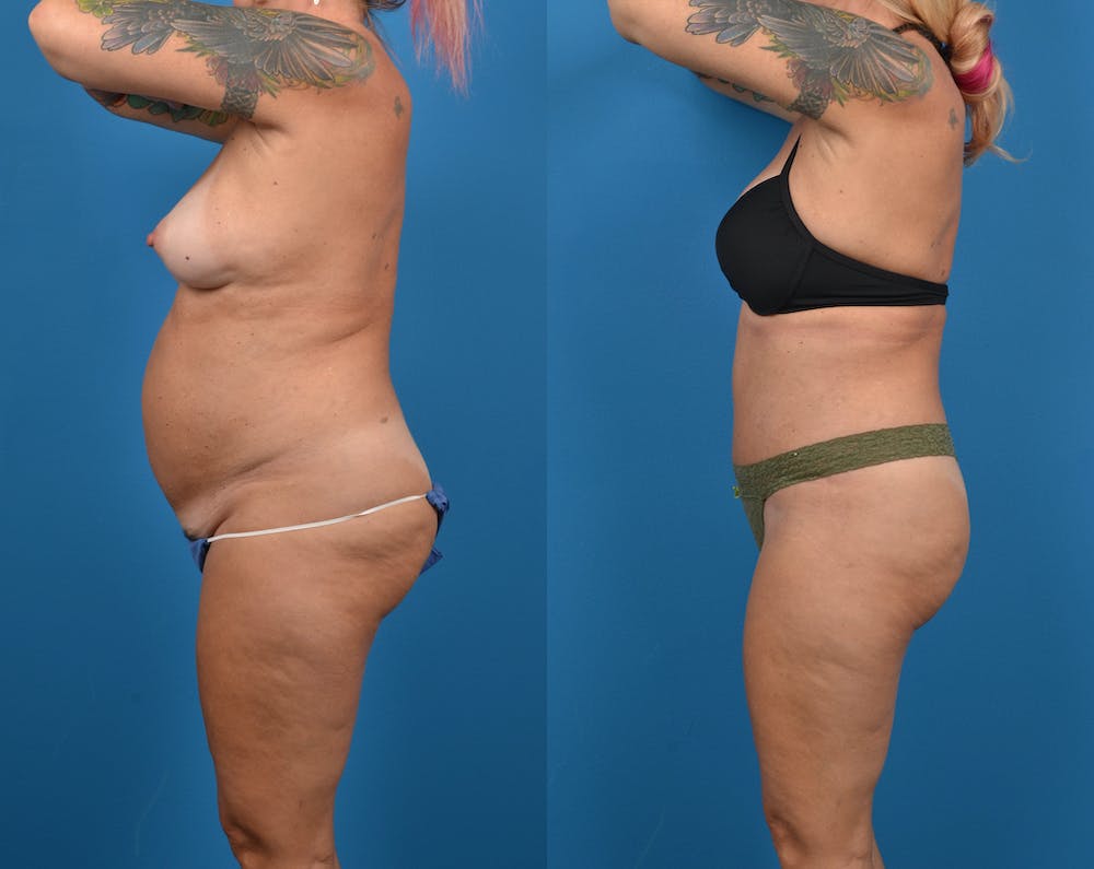 Abdominoplasty Before & After Gallery - Patient 14779091 - Image 3