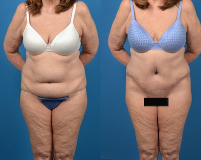 Abdominoplasty Before & After Gallery - Patient 14779095 - Image 1
