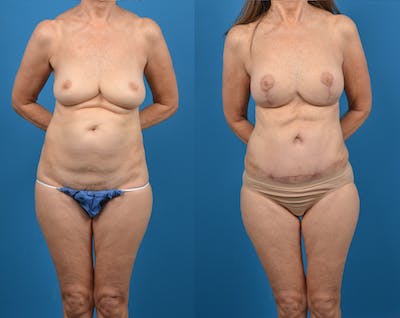 Abdominoplasty Before & After Gallery - Patient 14779107 - Image 1