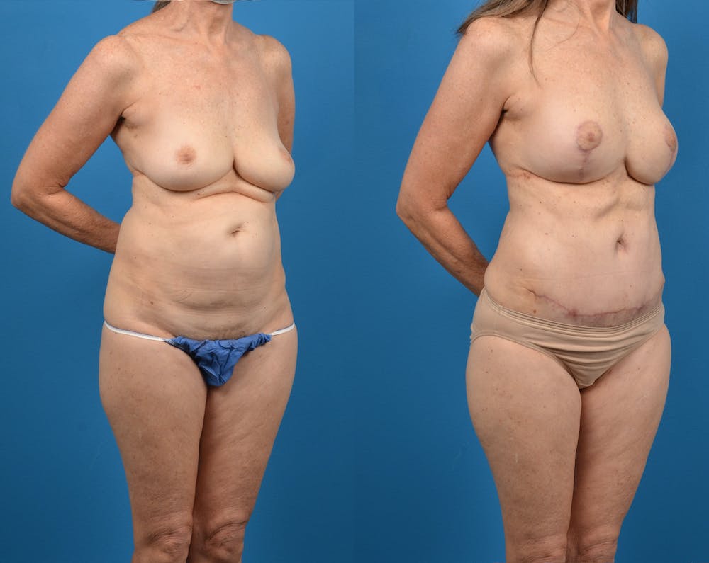 Abdominoplasty Before & After Gallery - Patient 14779107 - Image 2