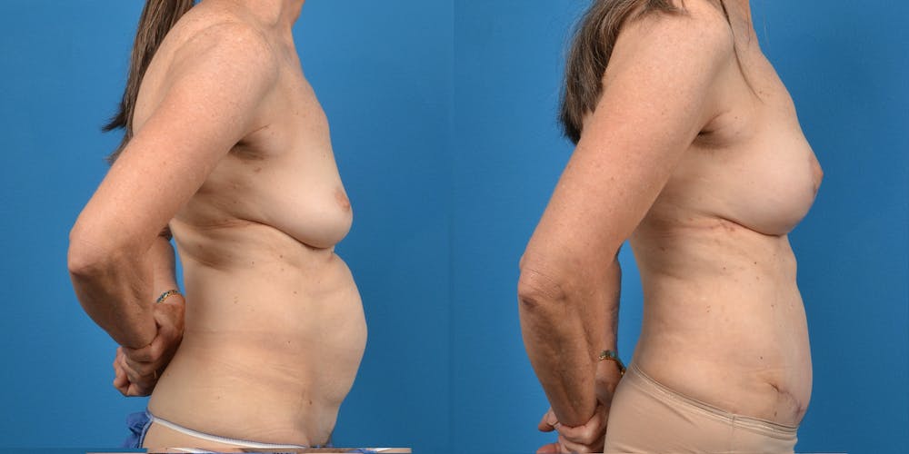 Breast Lift Before & After Gallery - Patient 14779114 - Image 3