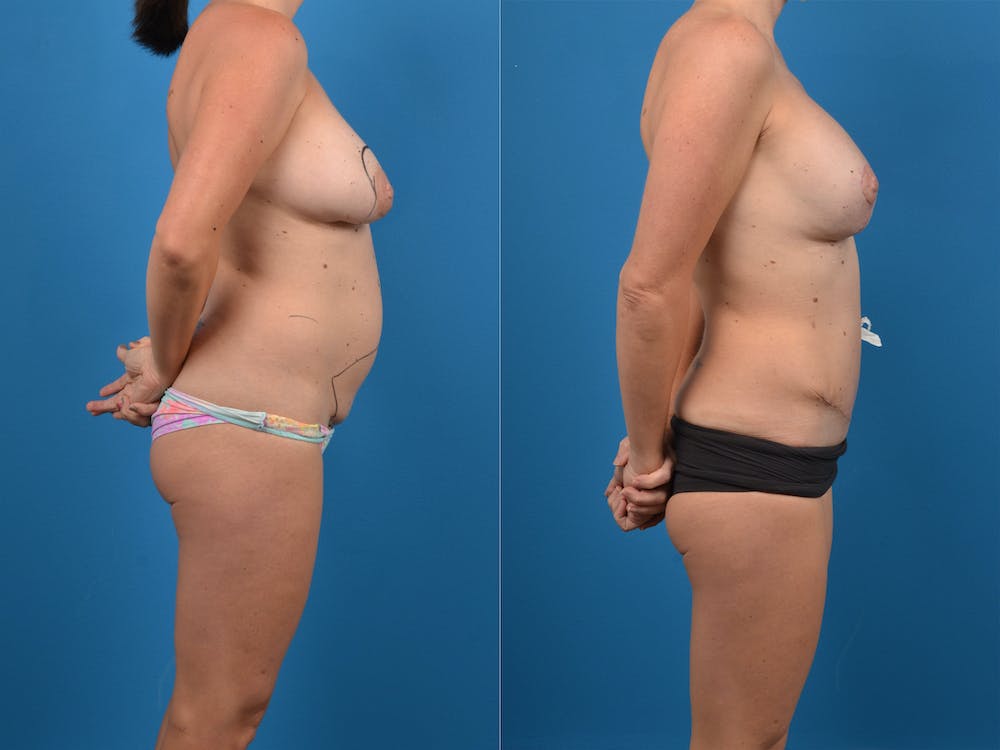 Mommy Makeover Before & After Gallery - Patient 14779121 - Image 1