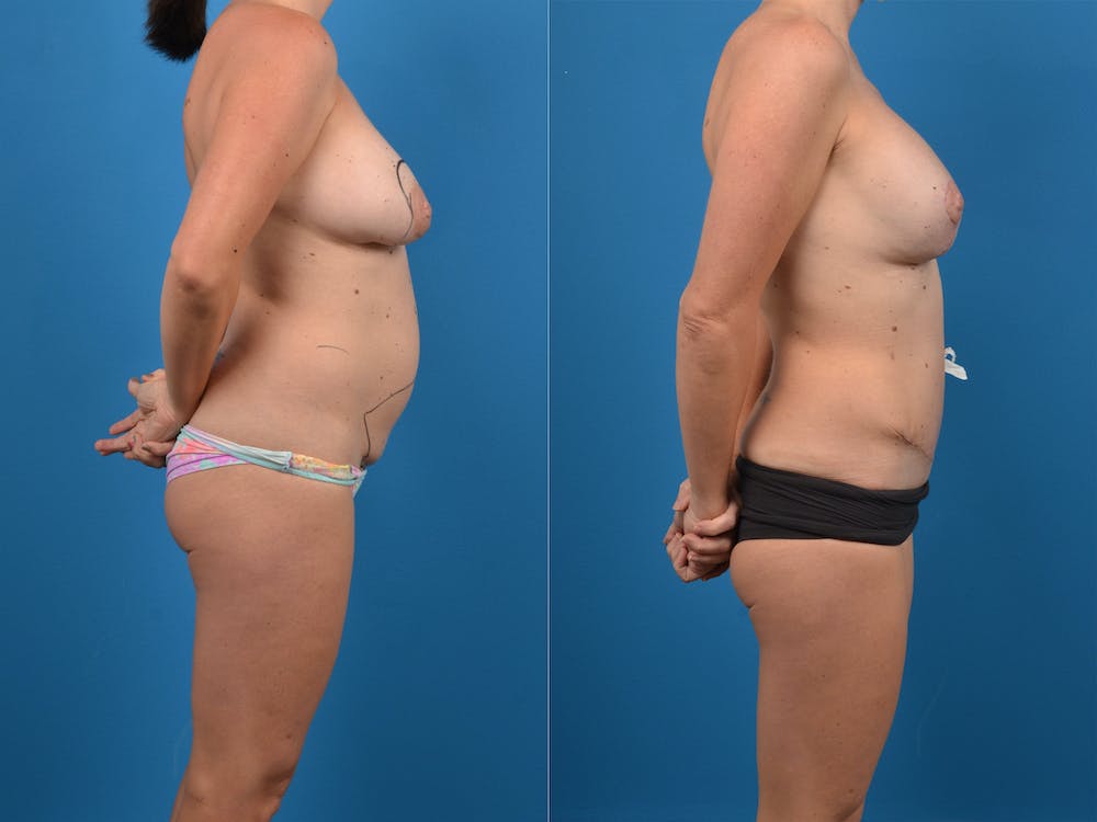 Abdominoplasty Before & After Gallery - Patient 14779120 - Image 1