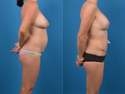 Mommy Makeover Before & After Gallery - Patient 14779121 - Image 1