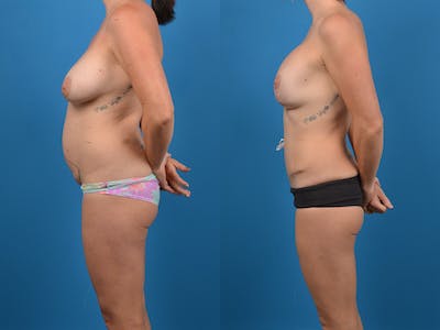 Mommy Makeover Before & After Gallery - Patient 14779121 - Image 2