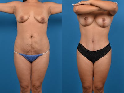 Mommy Makeover Before & After Gallery - Patient 14779154 - Image 1