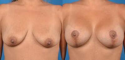 Breast Lift Before & After Gallery - Patient 14779162 - Image 1