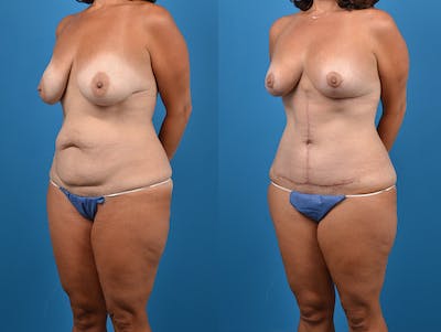 Mommy Makeover Before & After Gallery - Patient 14779178 - Image 2