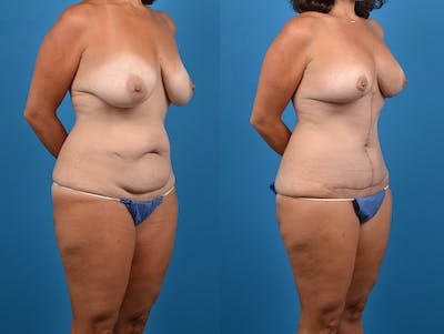 Abdominoplasty Before & After Gallery - Patient 14242433 - Image 4
