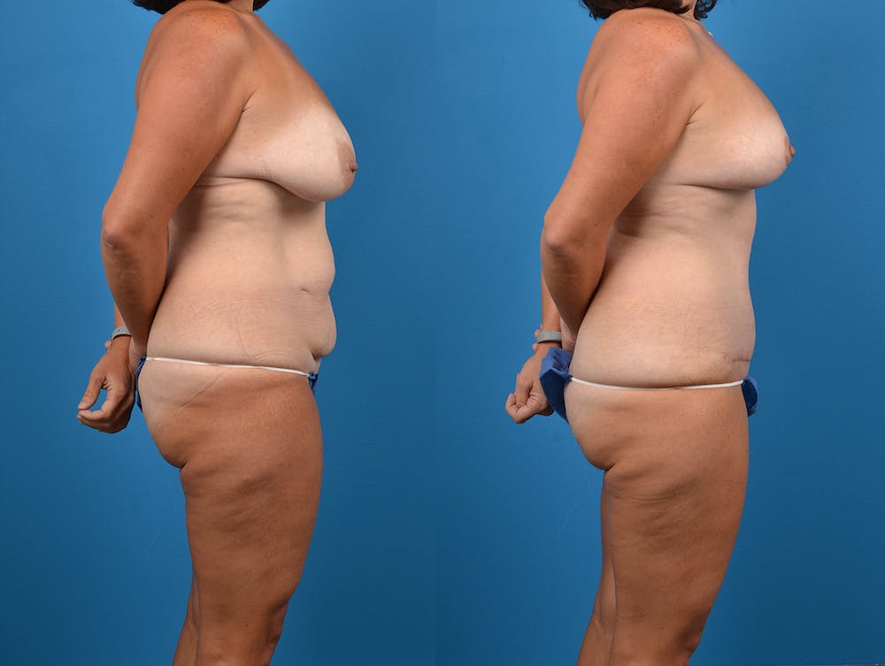 Post-Bariatric Surgery Before & After Gallery - Patient 14779180 - Image 5