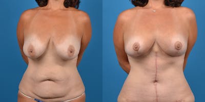 Breast Lift Before & After Gallery - Patient 14779179 - Image 1