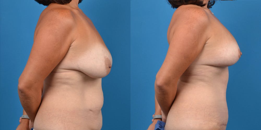 Breast Lift Before & After Gallery - Patient 14779179 - Image 5