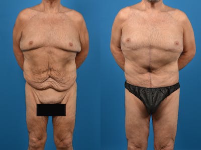 Post-Bariatric Surgery Before & After Gallery - Patient 14779217 - Image 1