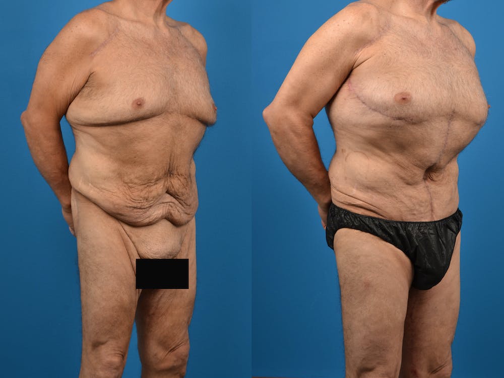 Body Contouring Before & After Gallery - Patient 14779218 - Image 3