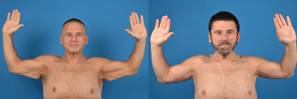 Brachioplasty Before & After Gallery - Patient 14779212 - Image 5