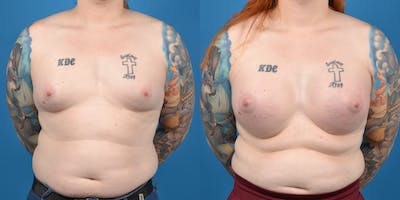 Transgender Surgery (MTF) Before & After Gallery - Patient 14779224 - Image 1