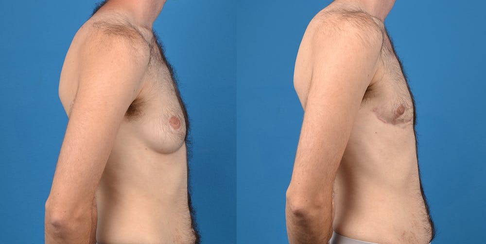 Transgender Surgery (FTM) Before & After Gallery - Patient 14242527 - Image 5