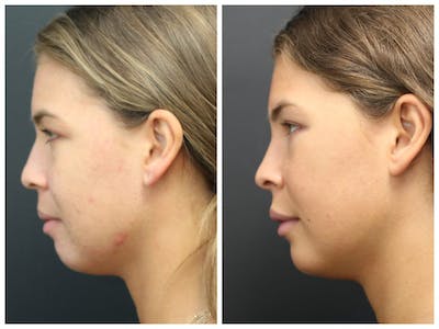 Acne Treatment Before & After Gallery - Patient 14779256 - Image 2